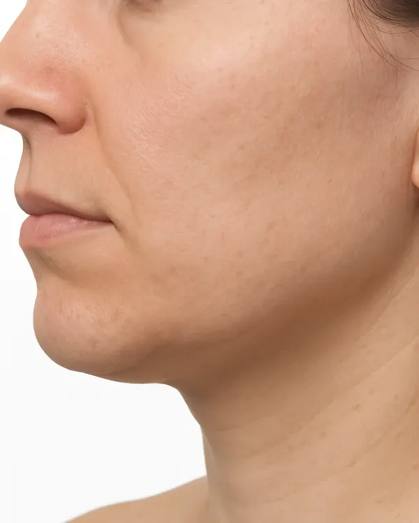 Face Slimming (Masseter) Treatment in Chiswick London