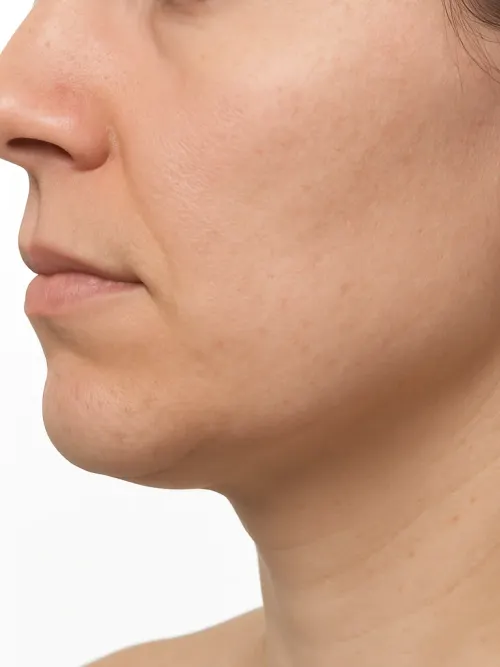Face Slimming (Masseter) Treatment in Chiswick London