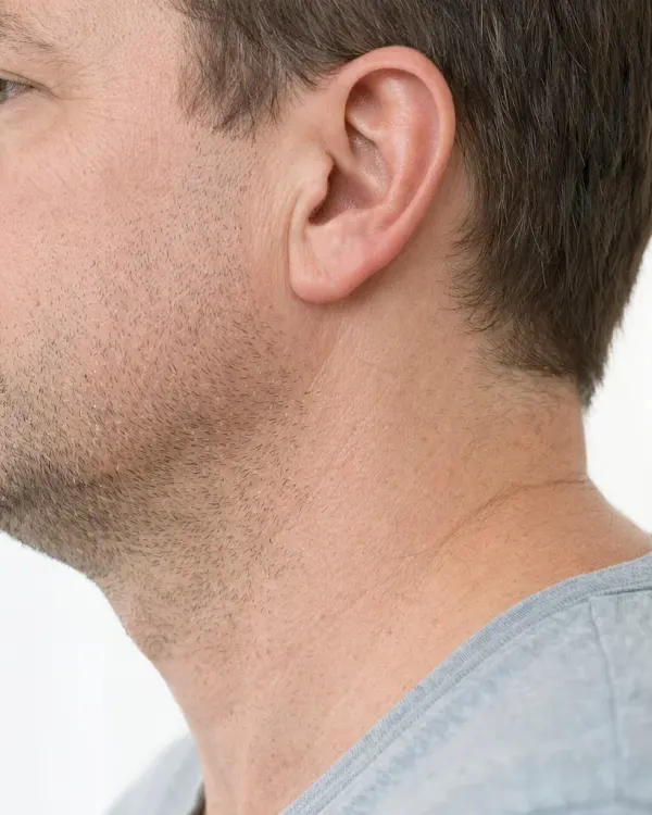 Jawline filler for men dr harry